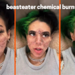 Beasteater Chemical Burns