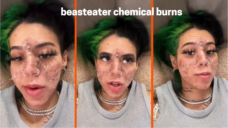 Beasteater Chemical Burns