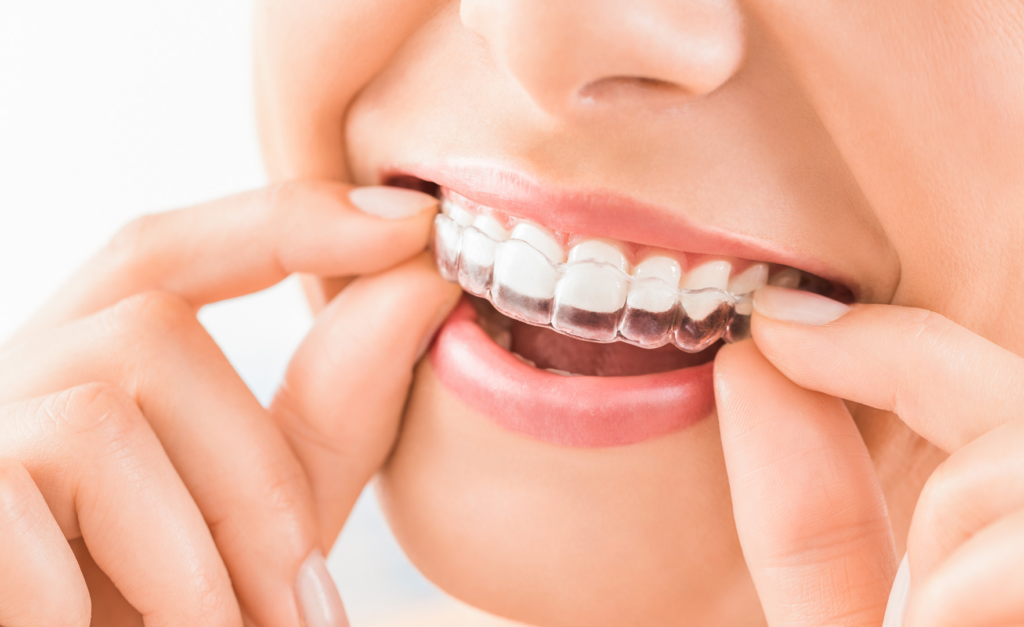 The Benefits of Choosing Invisalign for a Seamless Smile Makeover in St John's Wood